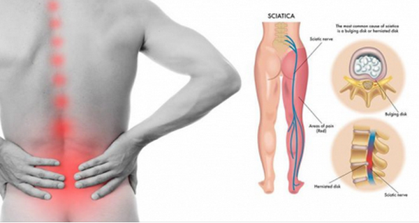 Get Rid Of Sciatica Nerve Pain With This Excelent Techniques