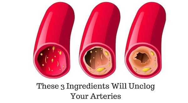 Make Excellent Coronary Arteries Cleanse with Just Three Ingredients