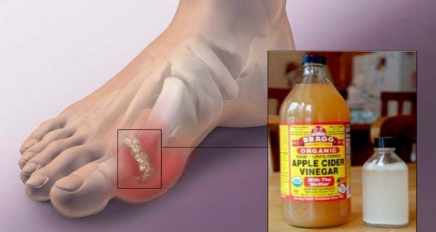 Uric Acid Crystallization Could Be a Big Problem: Prevent Gout and Joint Pain with This Tips and Tricks