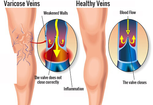 varicose-veins-copy