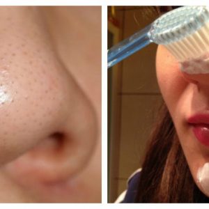 Using Toothpaste to Remove Blackheads