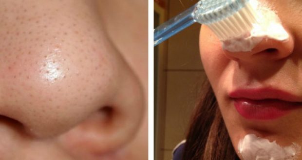 Using Toothpaste to Remove Blackheads