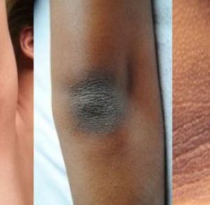 Do You Have Dry and Dark Skin on Your Knees, Elbows or Neck? Remove it with These Recipes