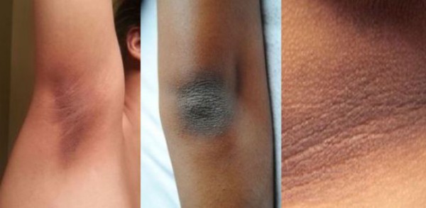 Do You Have Dry and Dark Skin on Your Knees, Elbows or Neck? Remove it with These Recipes