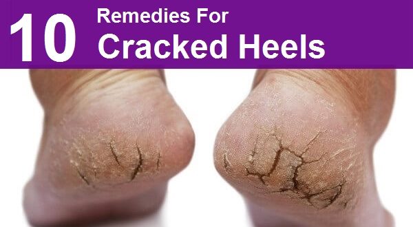 Do You Have a Problem with Cracked Heels? Solve It with These 10 Tricks