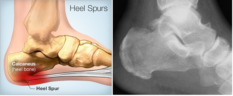 heel-spur-treatment - HealthInaSecond.com