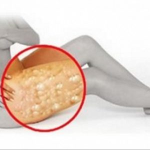 Get Rid of the Cellulite With Just Apple Cider Vinegar