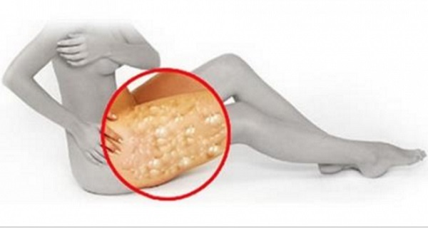 Get Rid of the Cellulite With Just Apple Cider Vinegar