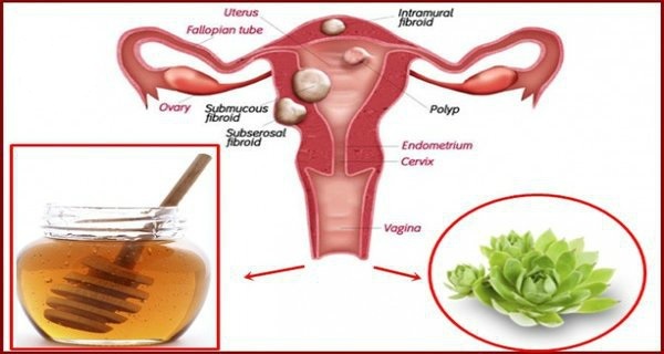 Destroy Cysts and Fibroids with This Natural Remedy