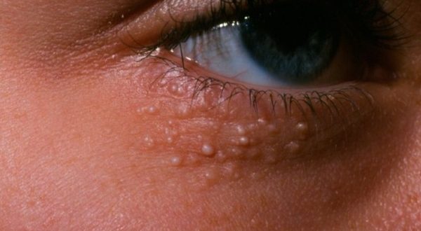 What Causes Small Pimples Around The Eyes