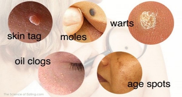 If You Have Problems With Warts, Moles And Blackheads, You Can Solve Them With These Natural Ways