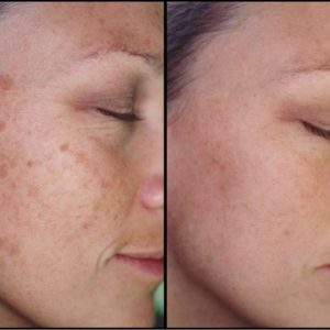 Remove Brown Spots From Your Skin With This Trick