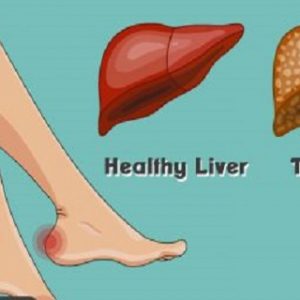 14 Symptoms That Can Be a Warning about Your Liver