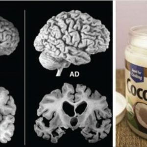 How Coconut Oil Can Help With Alzheimer, MS and Other Brain – Damaging Diseases!