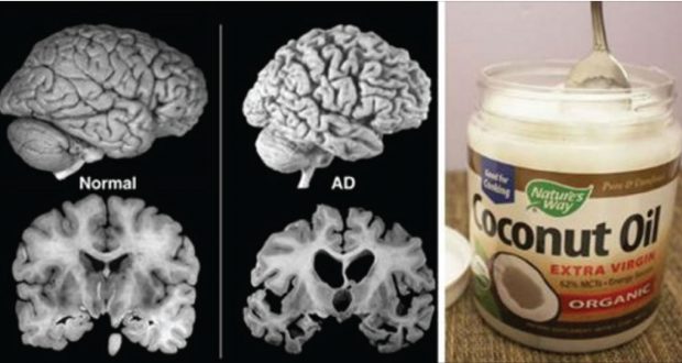 How Coconut Oil Can Help With Alzheimer, MS and Other Brain – Damaging Diseases!