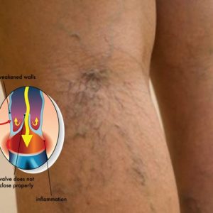 Do You Have Spider Veins? Here is How You Can Get Rid of Them!