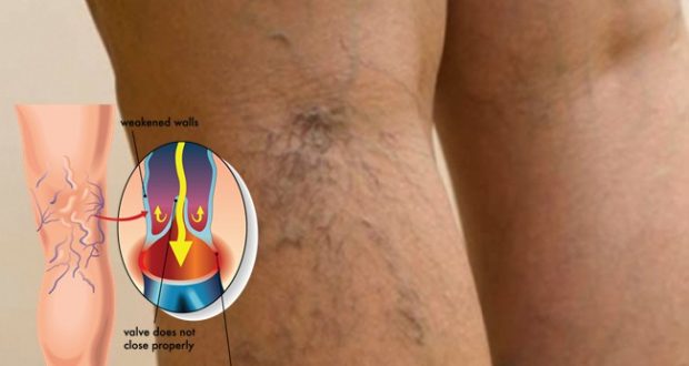 Do You Have Spider Veins? Here is How You Can Get Rid of Them!