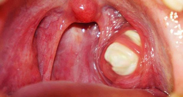 Tonsils: What to Do When They Appear And How To Treat Them At Home