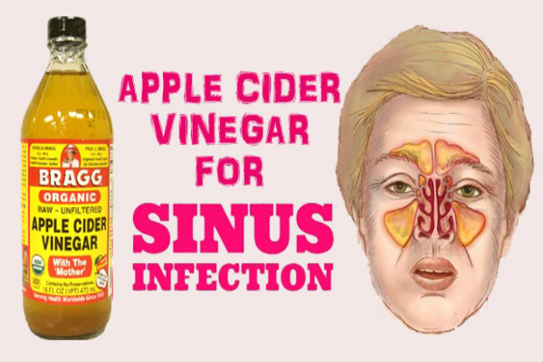 Get Rid of a Sinus Infection Using Apple Cider Vinegar in These Ways ...