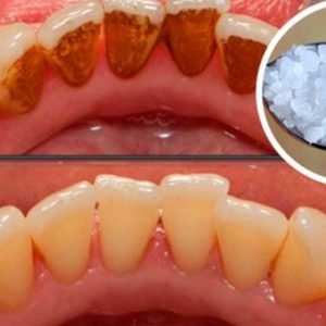 Use This Powerful Ingredient and Remove Tartar, Plaque and Bacteria from Your Mouth