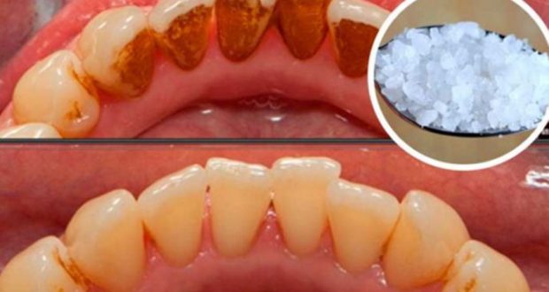 Use This Powerful Ingredient and Remove Tartar, Plaque and Bacteria from Your Mouth