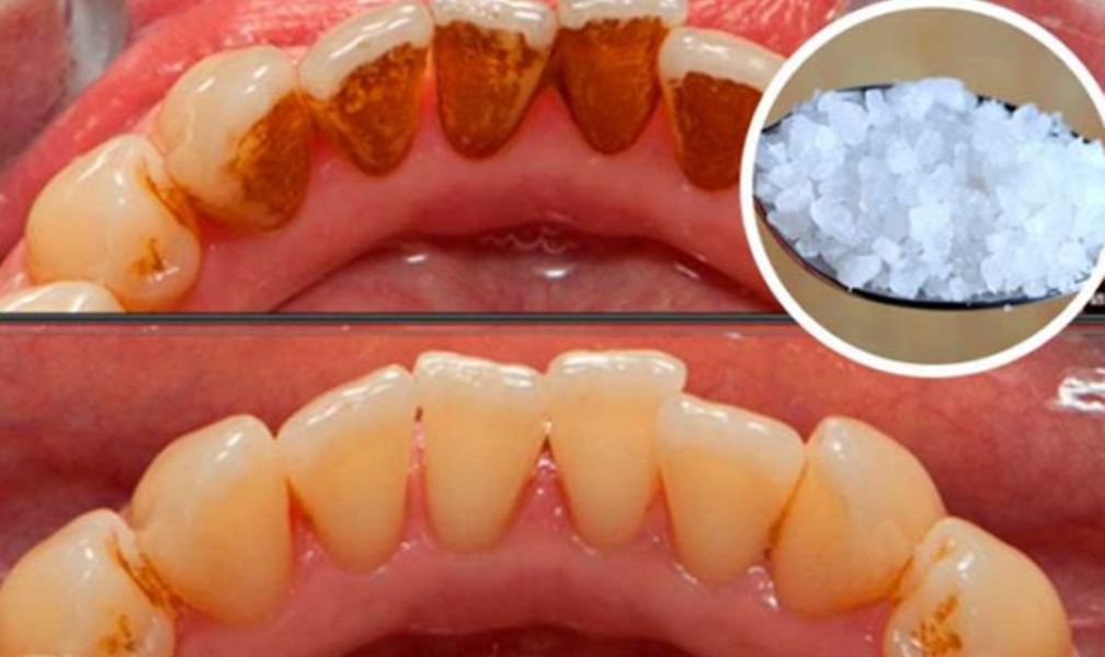 Use This Powerful Ingredient and Remove Tartar, Plaque and ...