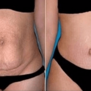 This Remedy Will Eliminate All Your Stubborn Belly Fat in Only 20 Days and You Just Need 10 Minutes to Make It