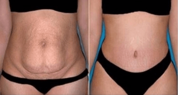 This Remedy Will Eliminate All Your Stubborn Belly Fat in Only 20 Days and You Just Need 10 Minutes to Make It