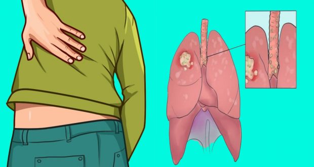 Don’t Ignore These Early Symptoms and Signs of Lung Cancer