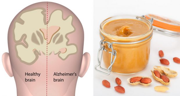 Here’s How You Can Use Peanut Butter To Diagnose Alzheimer’s Disease!