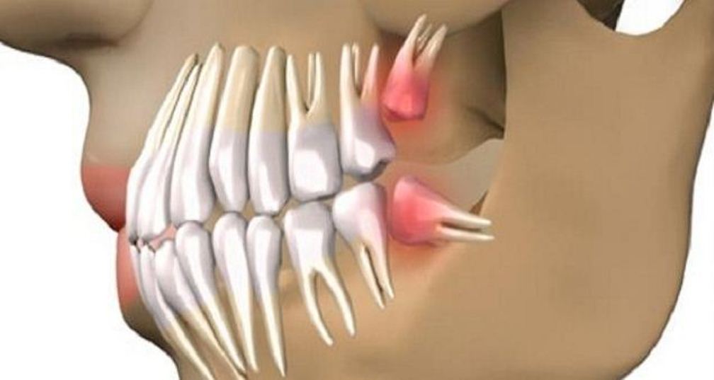 Revolution Is Happening: You Can Grow Your Own Teeth in Just 9 Weeks and Get Rid of Dental Implants