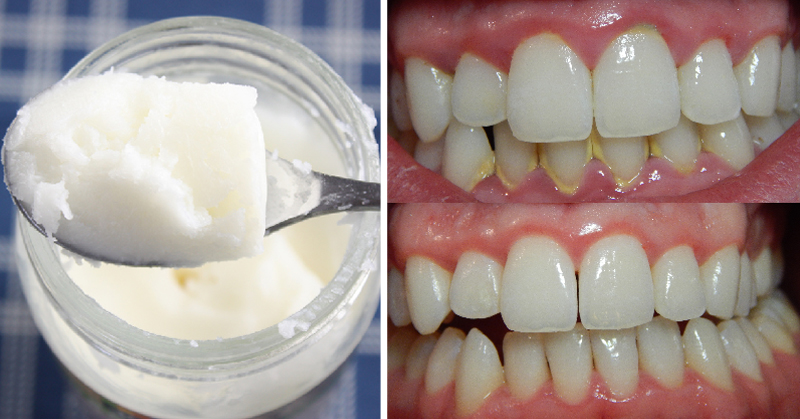 Leave Plaque, Bacteria and Bad Breath in the Past with One Ingredient