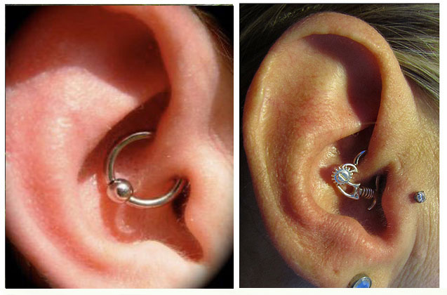 Things To Know About “Daith Piercing” As Potential Migraine Treatment