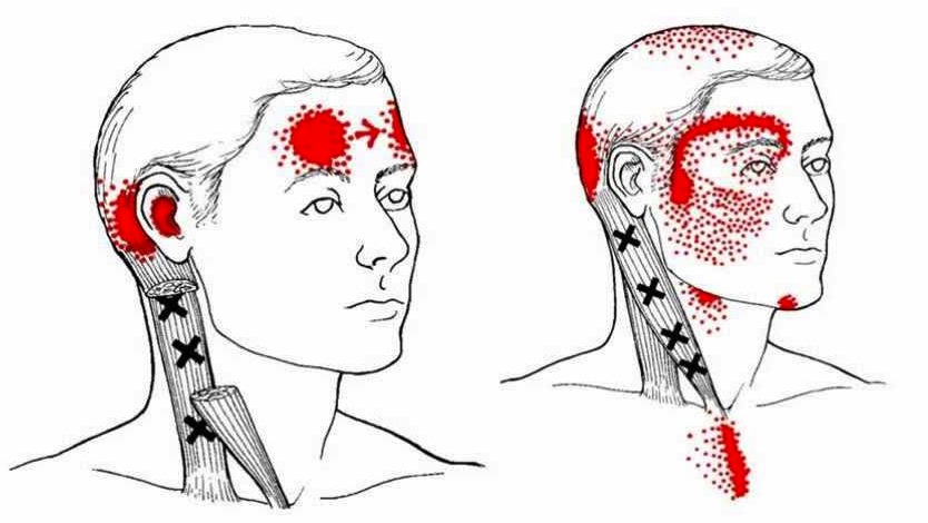 Боли в шее отдающие в голову. Триггерные точки грудино ключично сосцевидной мышцы. Миофасциальный синдром грудино-ключично-сосцевидной мышцы. Миофасциальный болевой синдром грудино-ключично-сосцевидной мышцы. Миофасциальный болевой синдром триггерные точки.