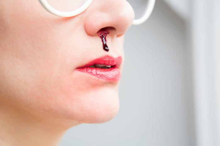 Do You Have Bleeding Nose? Here Are Some Facts and Remedies You Need to Know