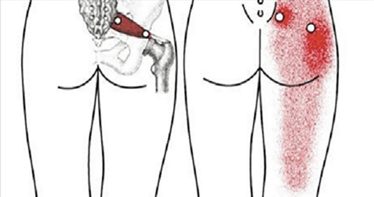 Back Pain and Sciatica Cannot Harm You If You Use This Remedy