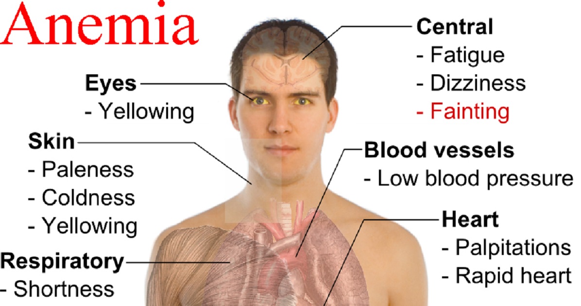 Iron Deficiency Anemia Signs And Symptoms