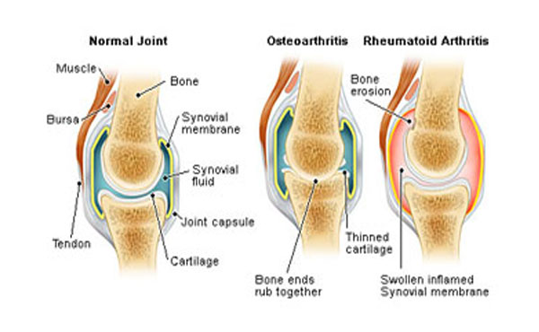 This Smoothie Can Help With Healing And Prevention Of Arthritis!