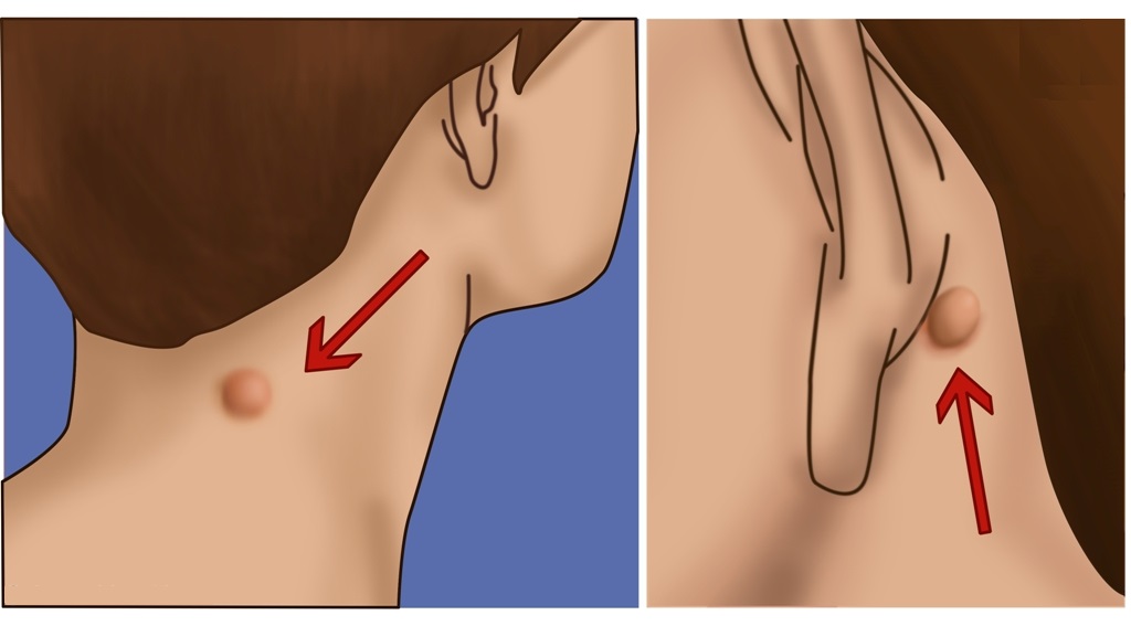 This is What Lump on Behind of Your Ear, Neck or Back Means