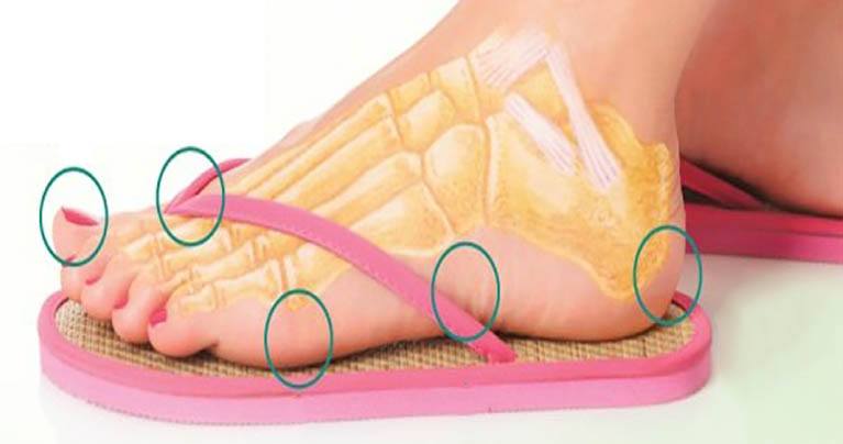 Did You Know That Flip Flops Are Dangerous? These Are 5 Ways They Can Harm You