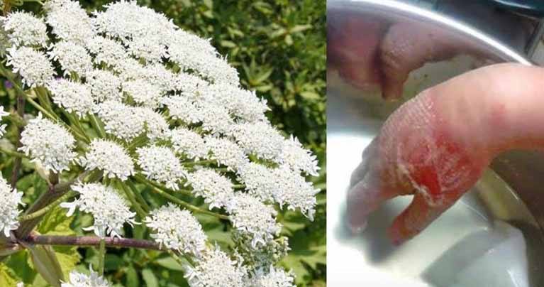 Be Careful: This Plant Can Cause Blindness and Burn Your Skin