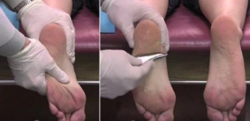 This Woman Went to The Chiropractor to Cure Terrible Pain in the Heels of Her Feet and Amazing Thing Happened (Video)