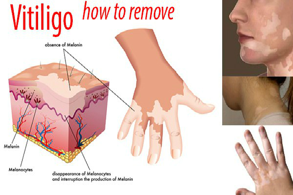 Vitiligo: Remove White Patches on Your Skin with These Natural Remedies