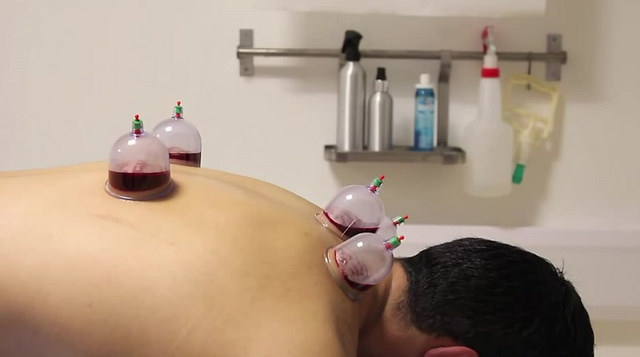 Did You Know What Hijama Is? This Procedure Is Life Saving!