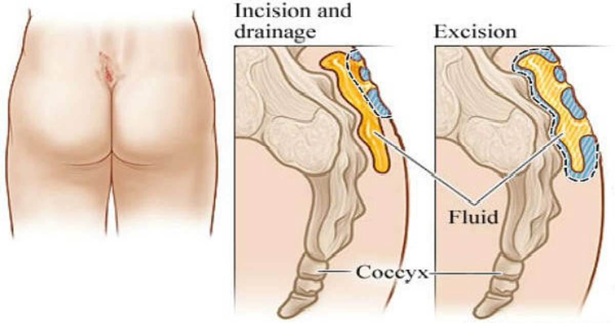 Pilonidal Disease: What It Is and How Do You Treat It