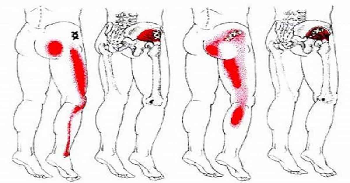 Sciatic Nerve Pain? Try This Effective Homemade Remedy