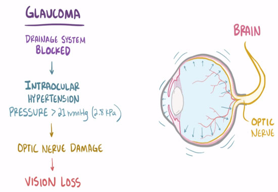 With This Protein Your Eyes Will Be Protected From Glaucoma!